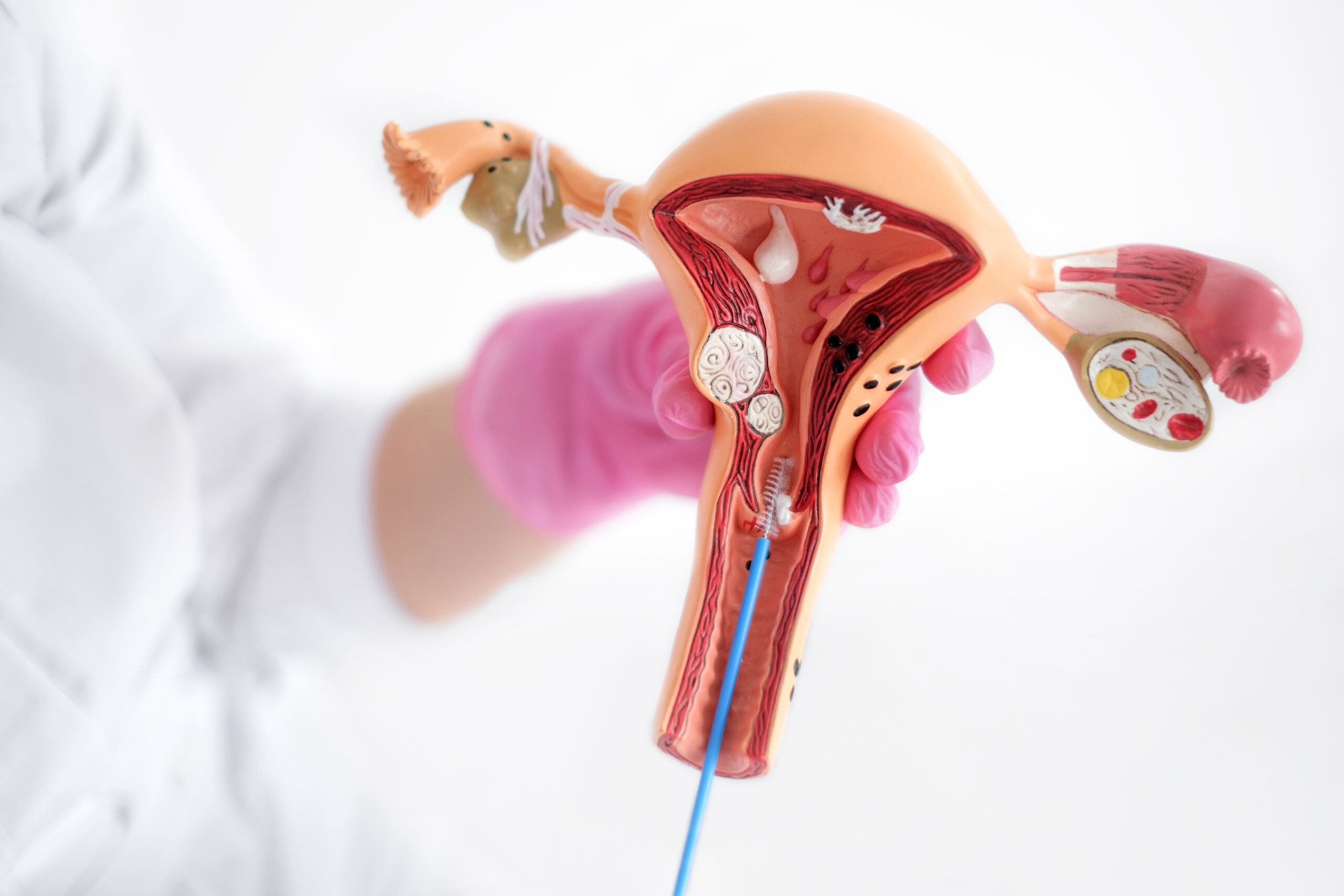 The doctor shows the process of taking an analysis on an anatomical model of uterus Hysteroscopy