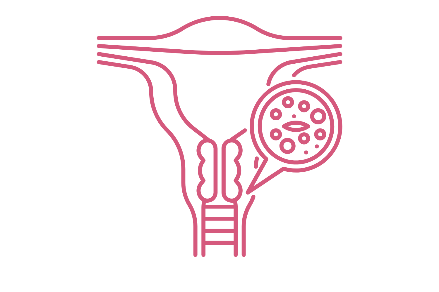 Cervical Cancer Cervical cancer