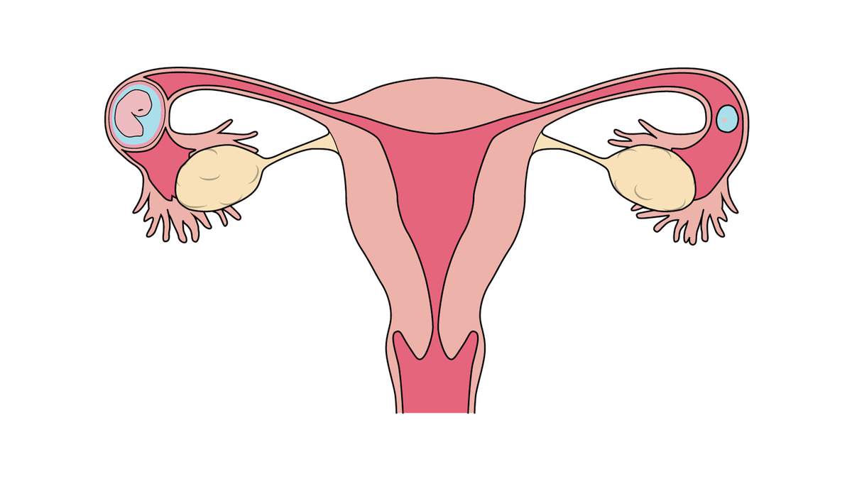 Ectopic Pregnancy- laparoscopy