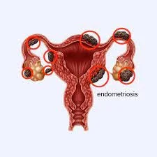 Endometriosis- Laparoscopy