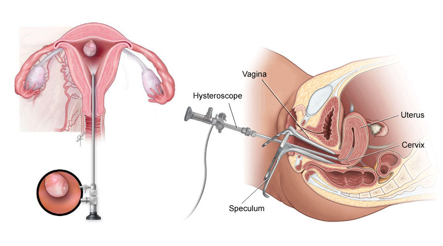 Hysteroscopy Image Hysteroscopy