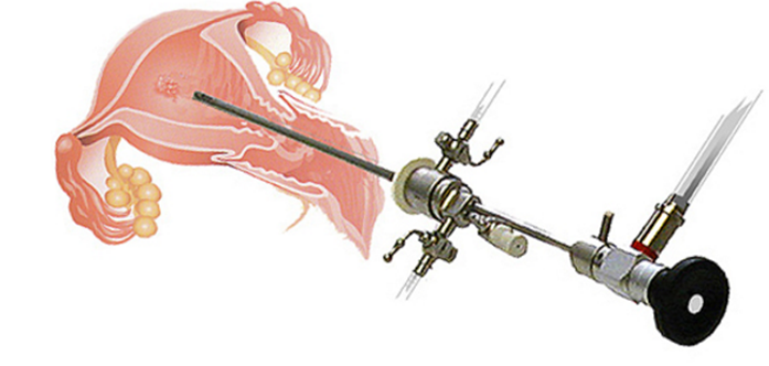 Hysteroscopy