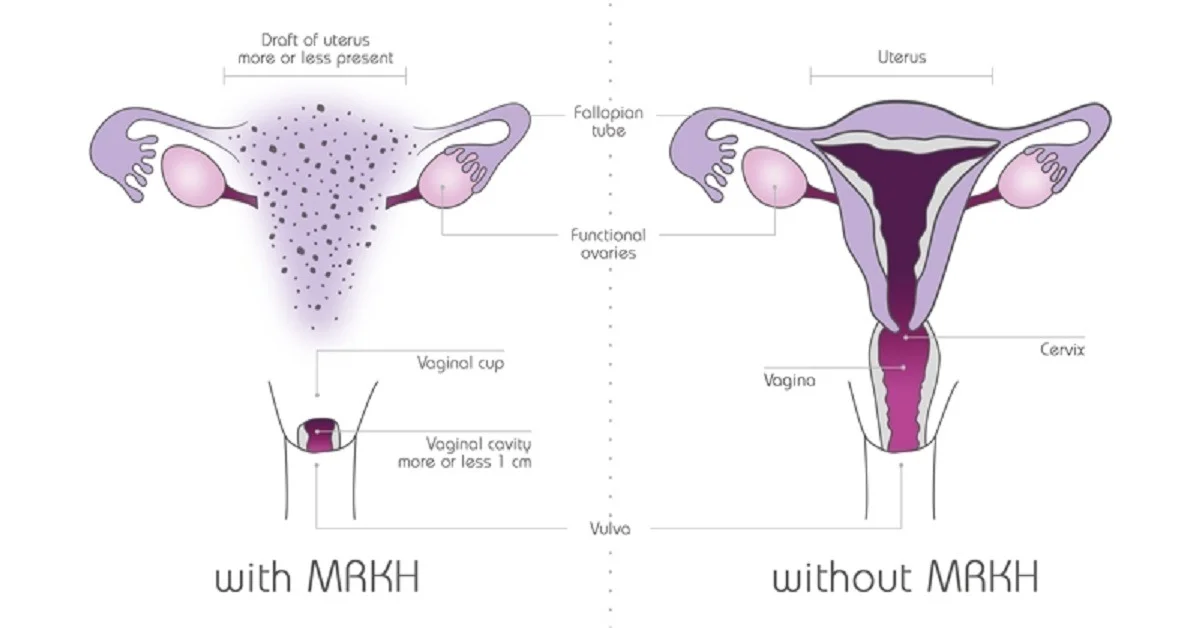 Indications for Indications for Laparoscopic Vaginoplasty Laparoscopic Vaginoplasty