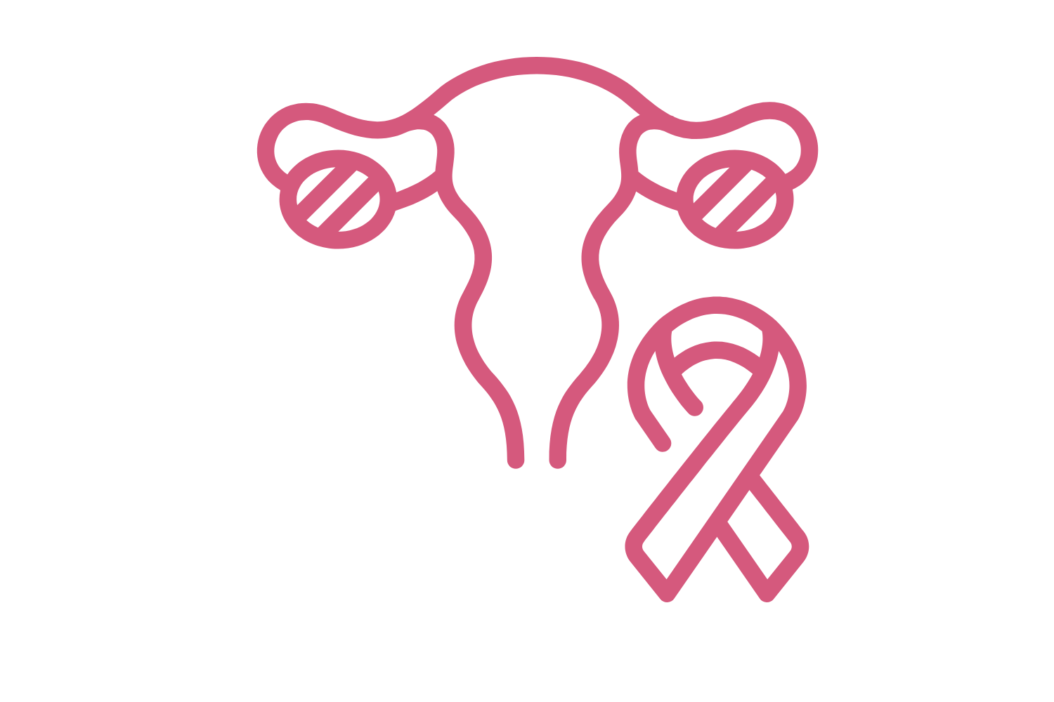 Ovarian Cancer Ovarian Cancer