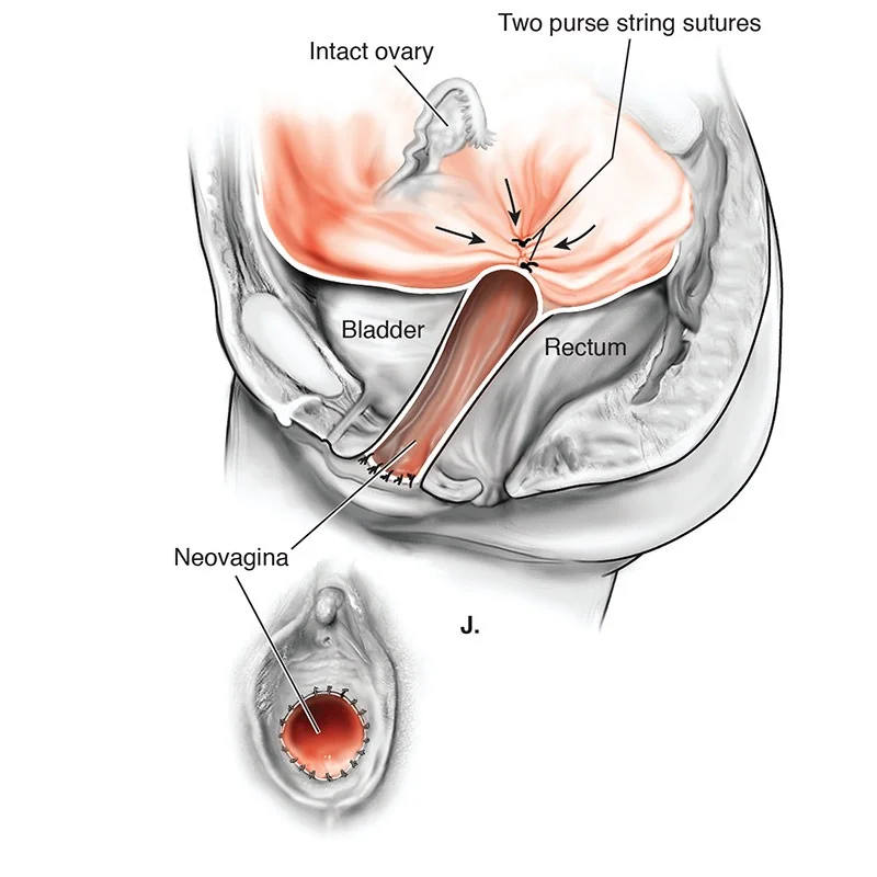 Procedure- Laparoscopic Vaginoplasty Laparoscopic Vaginoplasty