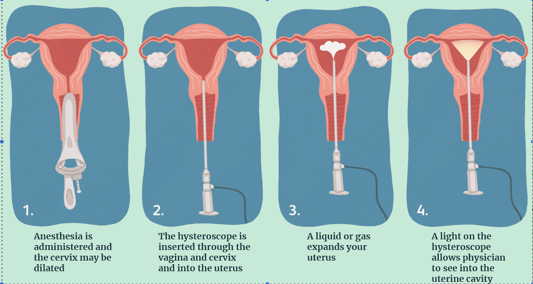 Process- Hysteroscopy Hysteroscopy
