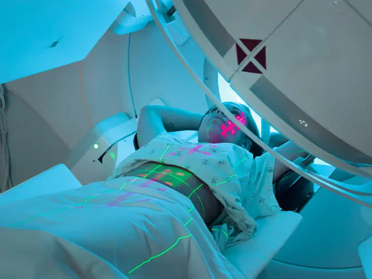 Radiation Therapy- Ovarian cancer Ovarian cancer