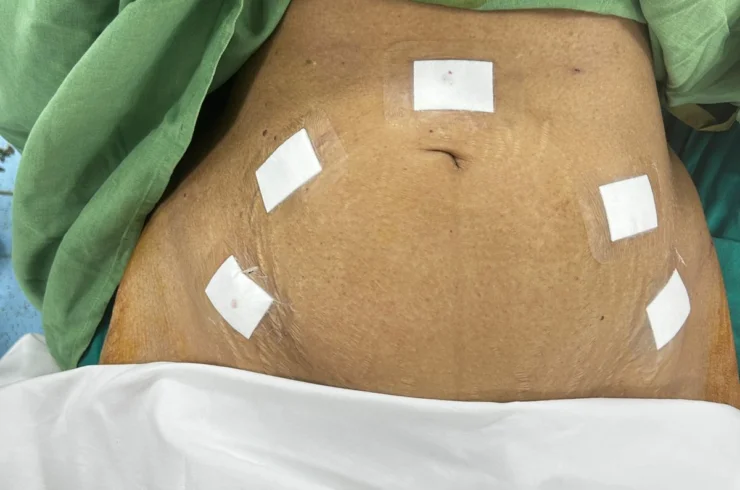 Role of Laparoscopy- Cervical cancer Cervical Cancer