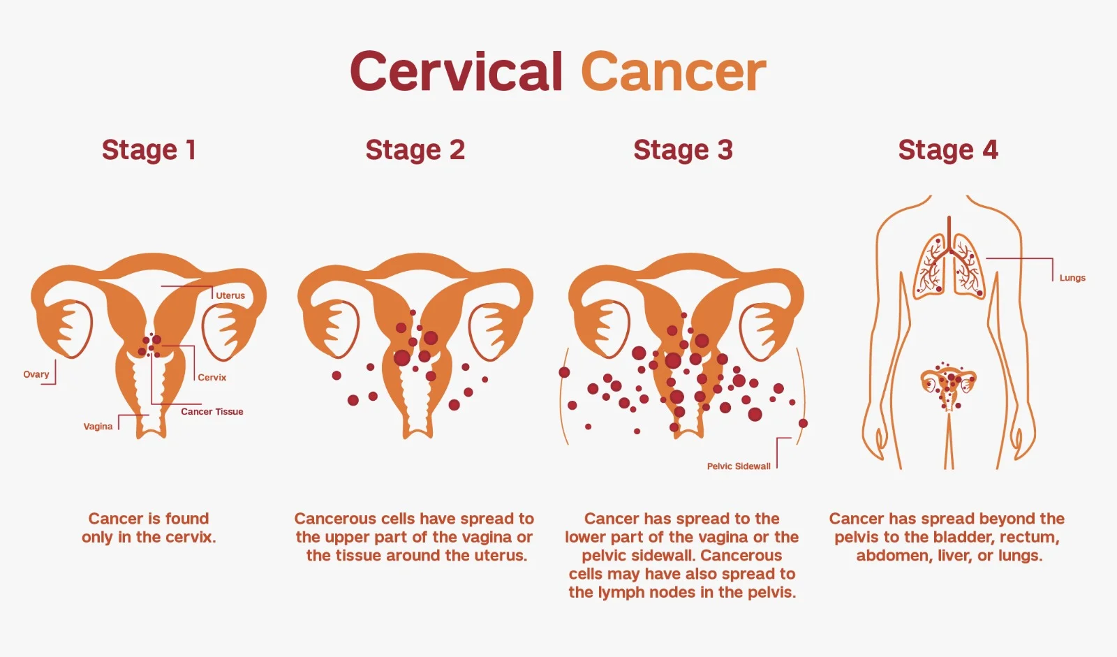 Stages of Cervical Cancer Cervical Cancer
