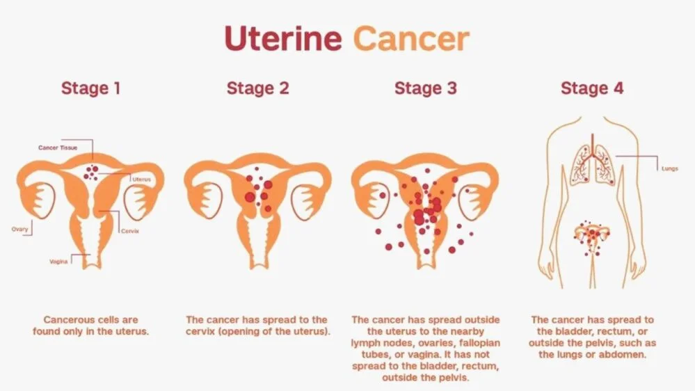 Stages of Uterine cancer Uterine Cancer