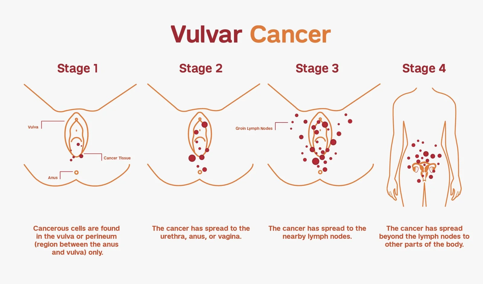 Stages of Vaginal cancer Vaginal cancer
