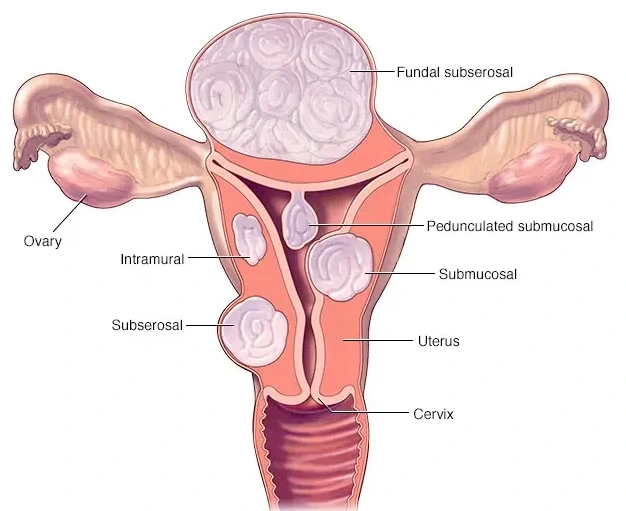 Uterine Fibroids- Laparoscopy copy Laparoscopy
