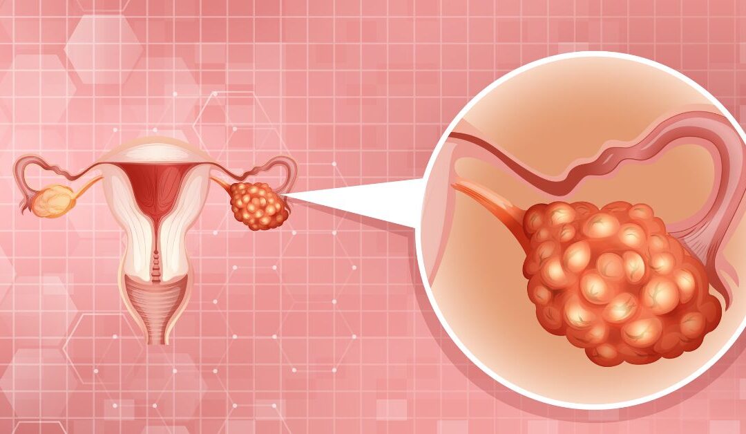 Why Are More Young Women Facing Ovarian Cysts Than Ever Before