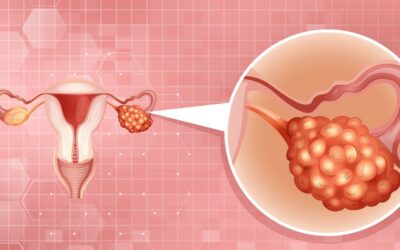 Why Are More Young Women Facing Ovarian Cysts Than Ever Before